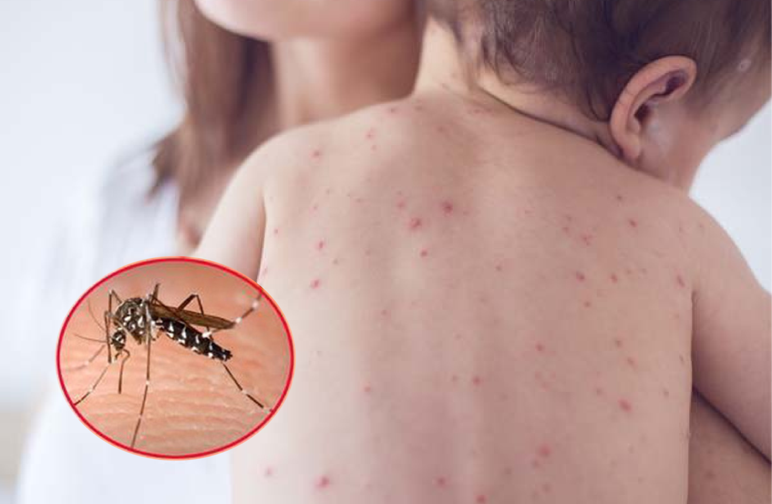 Sốt xuất huyết dễ bị nhầm lẫn với cảm cúm thông thường ở giai đoạn đầu