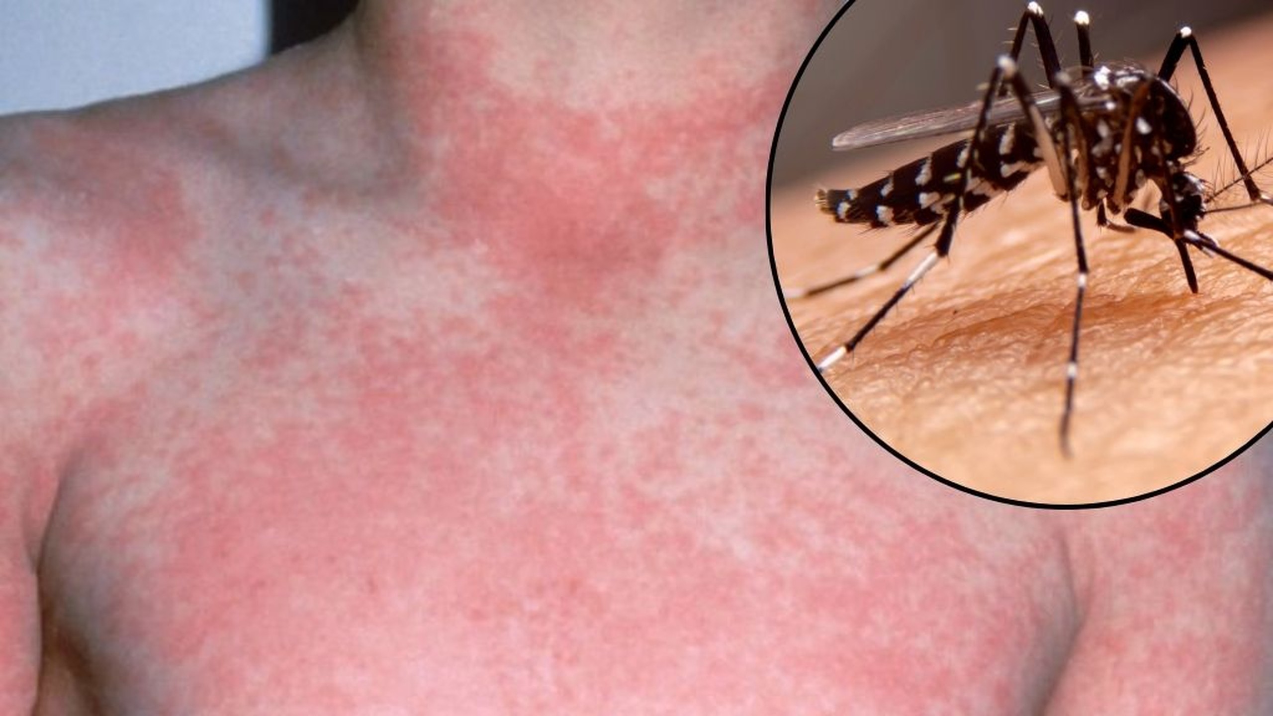 Bệnh nhận cần nhập viện để tránh tình trạng xuất huyết nặng