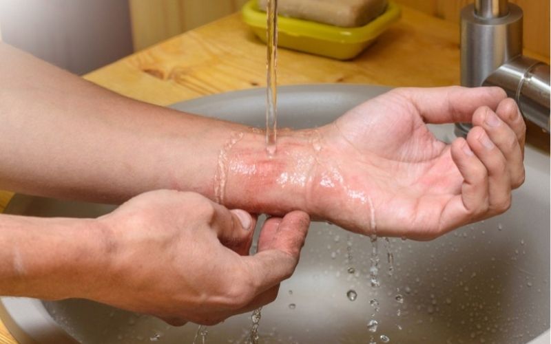 Rửa sạch vết đốt dưới vòi nước và xà phòng là bước đơn giản khi bị kiến tấn công