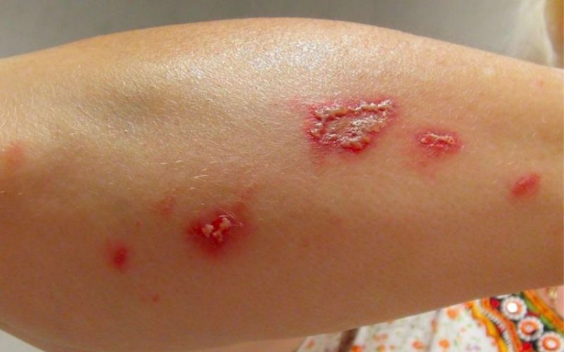 Hạn chế chạm tay vào vết phồng rộp để tránh nhiễm trùng nhất khi bị đốt 