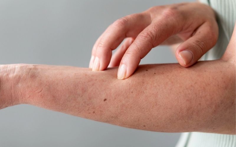 Ngứa da không dứt dù đã dùng thuốc bôi có thể là dấu hiệu suy thận